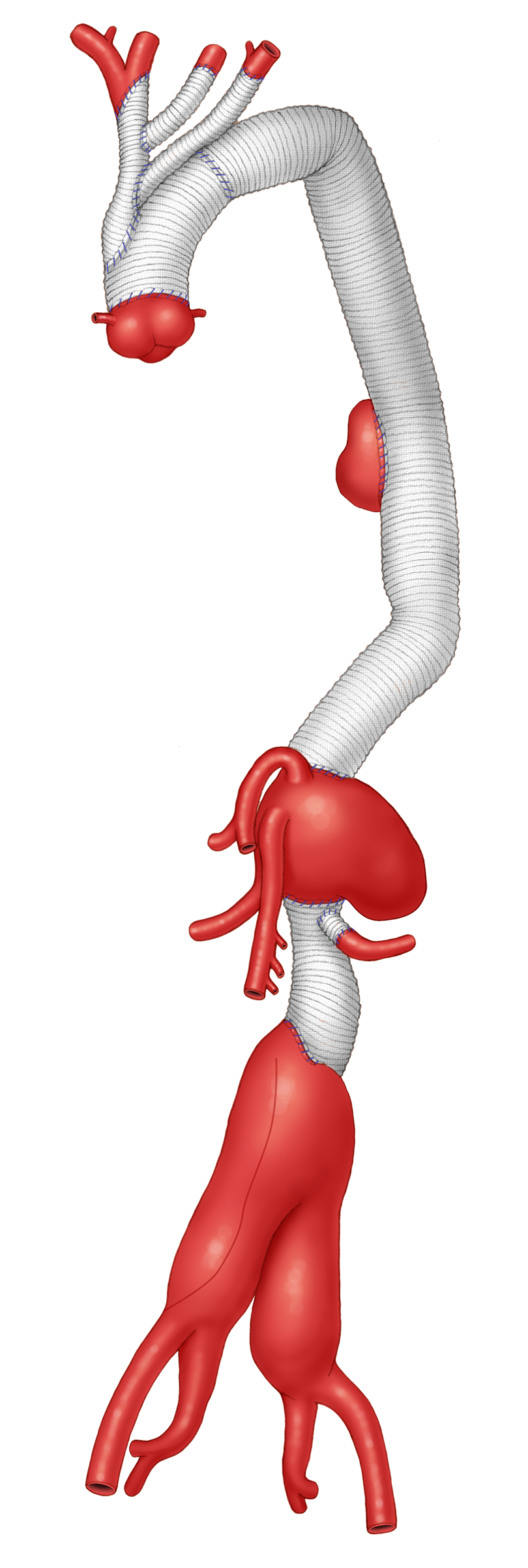 Complex Open Aneurysm Repair — illustration