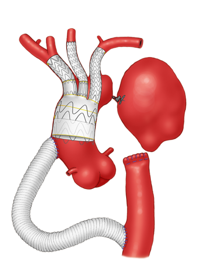 3-Vessel Custom-Made Arch Repair — illustration