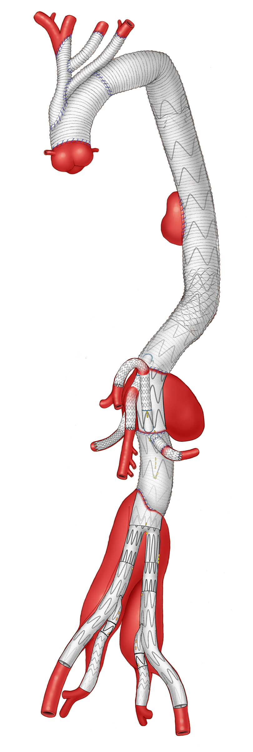 FB-EVAR in a patient with a previous open thoracoabdominal repair