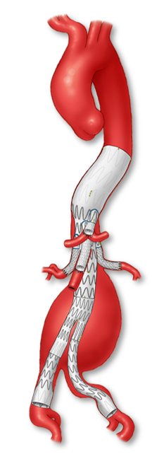 Fenestrated & Branched EVAR (FB-EVAR) — illustration