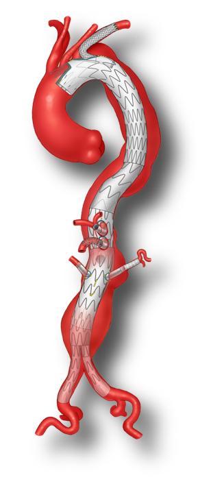 Thoracic Branched Endoprosthesis (TBE) — illustration