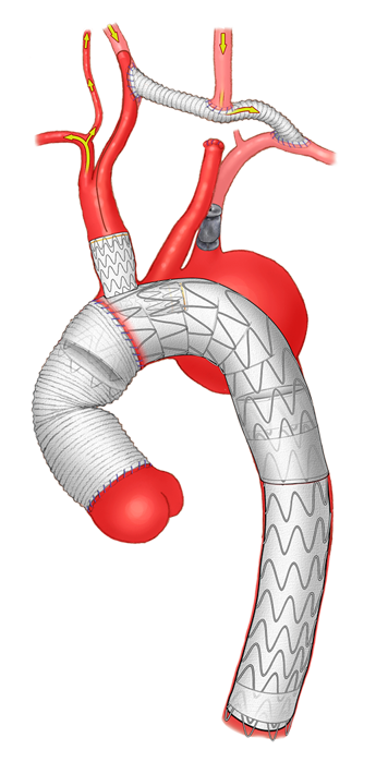 Cervical debranching with a thoracic branched endoprosthesis