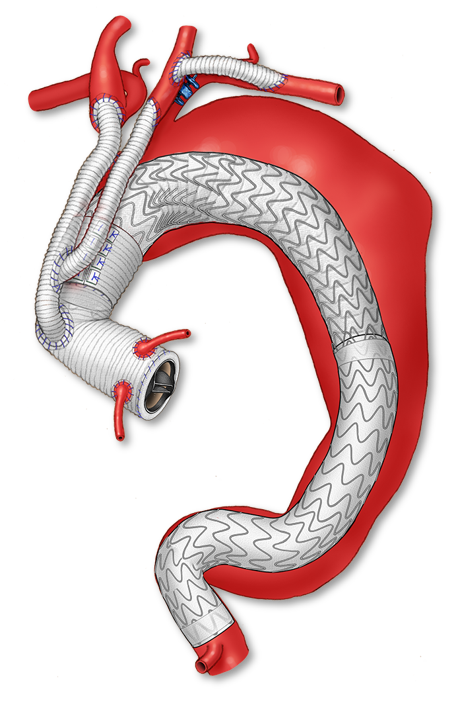 Hybrid Arch Repair — illustration