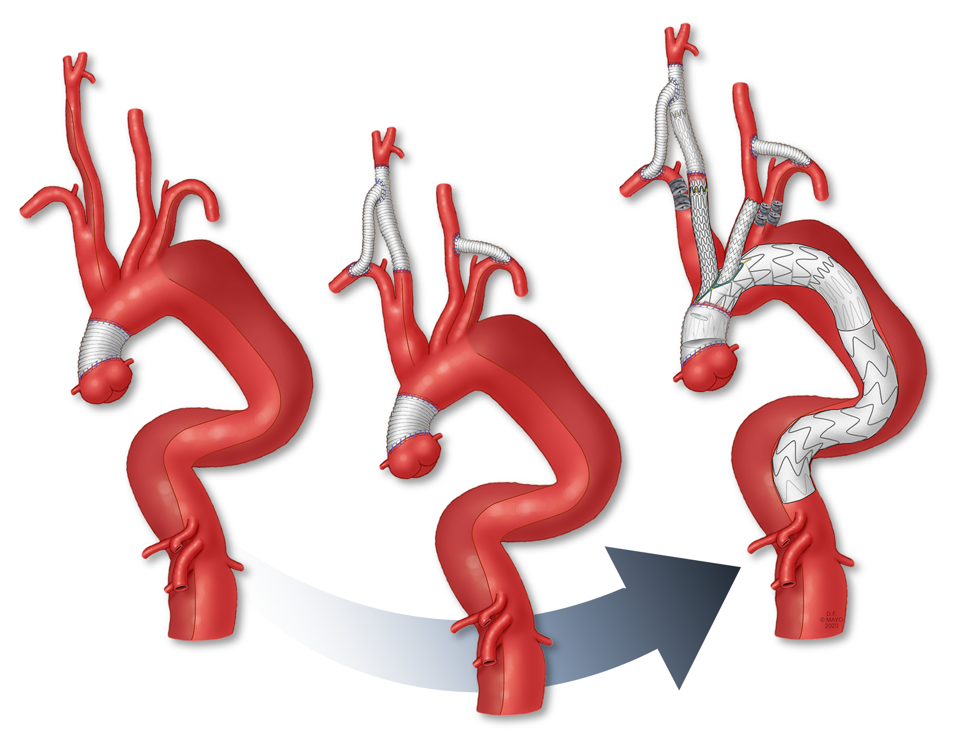 Step-by-step cervical debranching and aortic arch repair