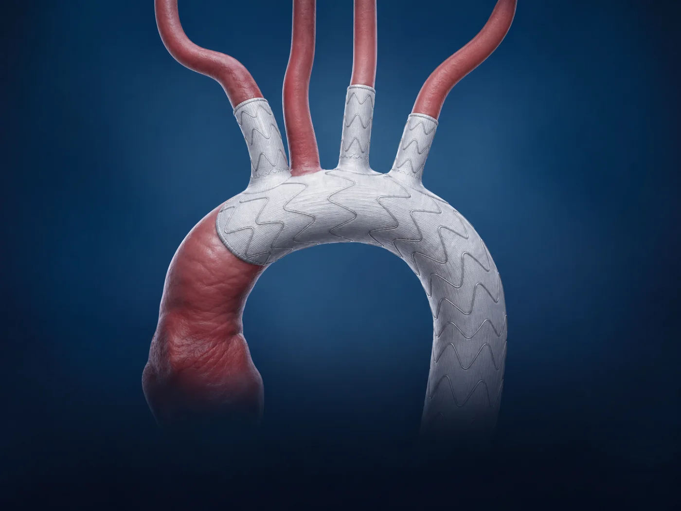 Patient-specific three-vessel aortic arch endograft
