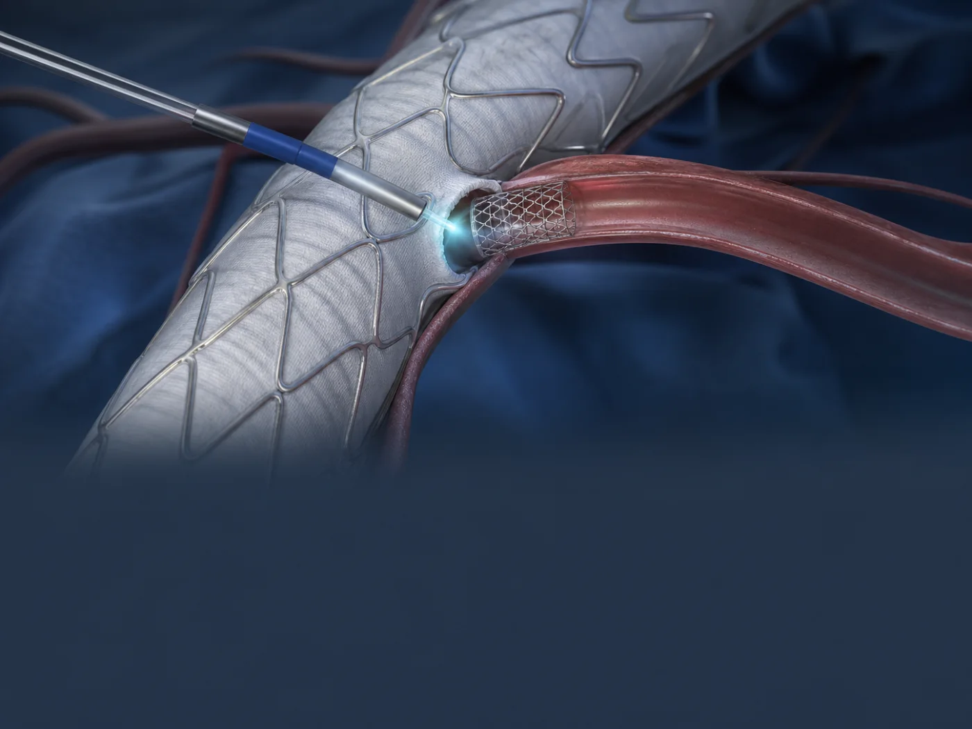 Laser fenestration creating a branch opening in an aortic stent-graft
