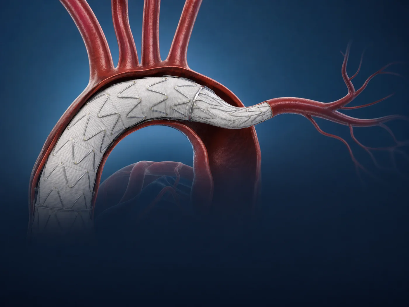 Thoracic branched endoprosthesis preserving an aortic arch branch