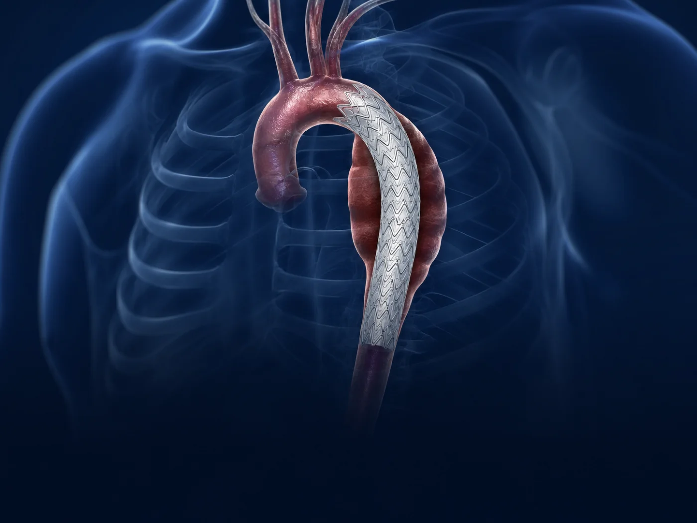 Thoracic endovascular stent-graft excluding a descending aortic aneurysm