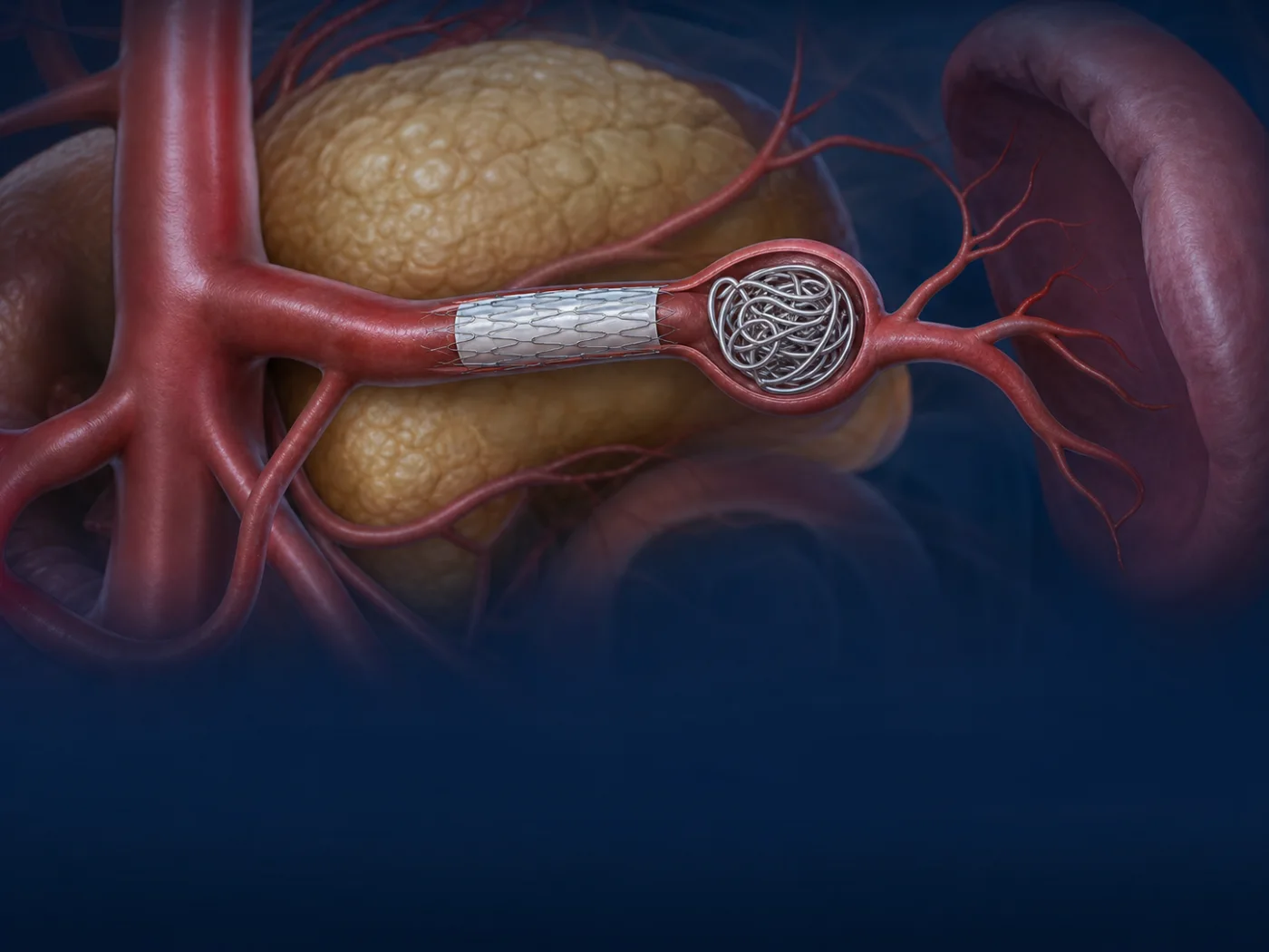 Coils and covered stent treating a visceral artery aneurysm